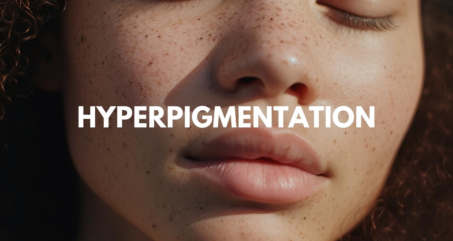 Hyperpigmentation