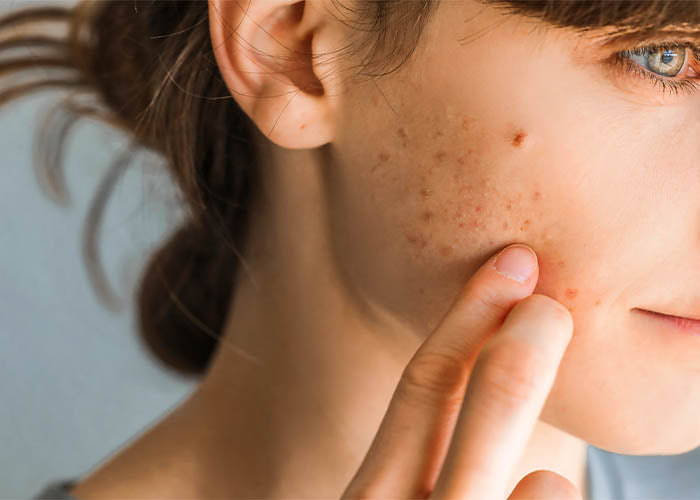 ACNE SKIN HEALTH SYSTEM